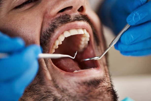 Best Emergency Tooth Extraction in Richgrove, CA